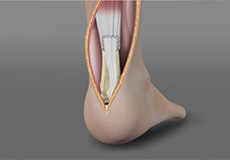 Achilles Tendon Repair