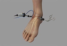 Ankle Arthroscopy