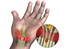 Carpal Tunnel Release Surgery