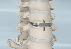 Cervical Disc Replacement