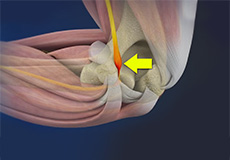 Ulnar Nerve Entrapment (Cubital Tunnel Syndrome)