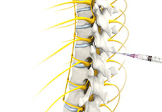 Epidural Steroid Injections