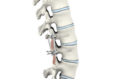 Lumbar Interbody Fusion