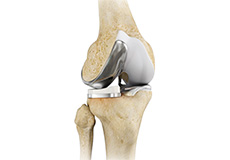 Unicompartmental Knee Replacement