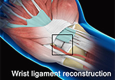 Wrist Ligament Reconstruction